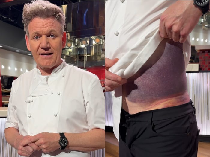 Gordon Ramsay Shows Bruises from Bike Accident