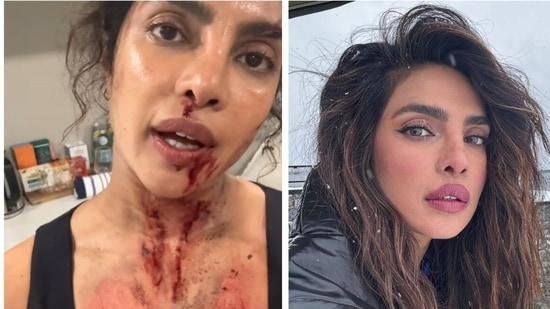 Priyanka Chopra Shows Bruises and Scars Endured While Filming Bloody Action Movie